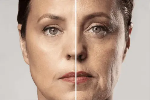 Rejuvenecimiento facial profundo con CO2 Fraccionado